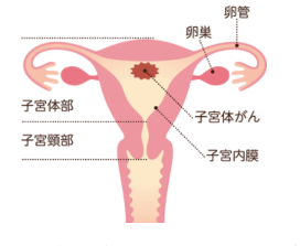 子宮体がんの発生箇所